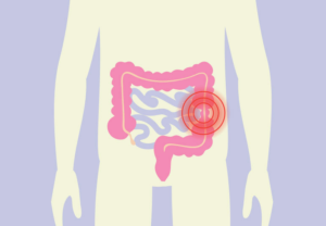 Irritable Bowel Syndrome (IBS) Treatment