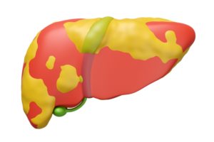 Fatty Liver Treatment
