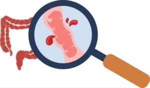 Treatment for Gastrointestinal Bleeding